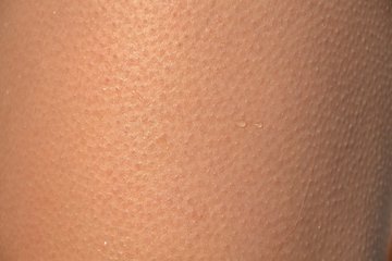 Эндокринолог Киселева перечислила опасные болезни, на которые могут указать «мурашки»