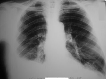 Врач Гулакова: кальян вызывает рак мочевого пузыря