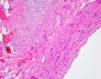 Эксперт Бхарадиа предупредила о «тихой» смертельной опасности гипертонии
