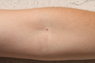 Онколог Старостин: выпуклые родинки – самые опасные