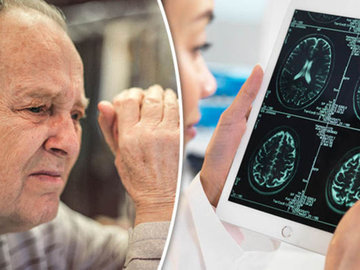 Что нужно знать про болезнь Альцгеймера? Первые признаки для беспокойства