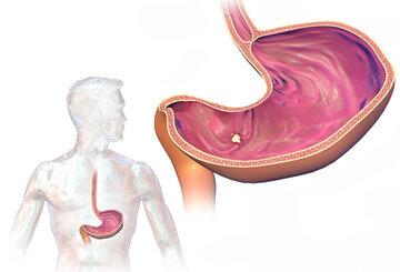 Онколог Д’Альпино: изжога может превратиться в рак