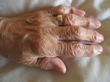 Невролог Зинчева: деменция проявляется небрежностью в быту