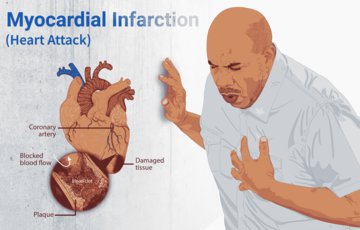 Хирург Лахмай: инфаркт миокарда отличается страхом смерти