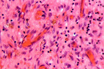 Флеболог Ярахмедов: тромбоз опасен ампутацией конечностей