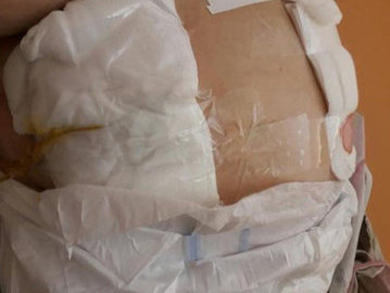 В Благовещенской горбольнице пожилой женщине перевязали операционную рану скотчем
