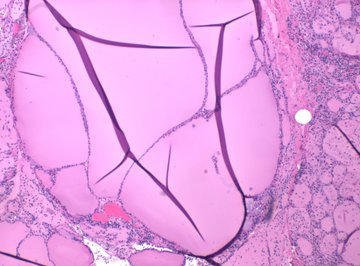 Врач Баранова раскрыла разницу между тиреоидитом и гипотиреозом