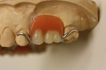 Ортодонт Буторина: удар мячом в лицо грозит смещением зубов