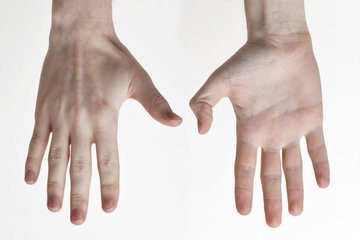 DM: британка с раком кожи назвала пятно на ногте первым симптомом