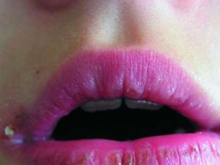 Как избавиться от надоедливой заеды?