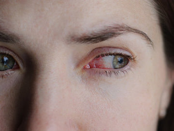 6 лекарственных препаратов, которые вызывают синдром сухого глаза