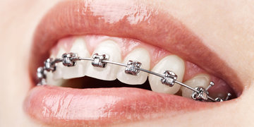 Самолигирующие, невидимые, керамические и другие типы брекетов для выравнивания зубов