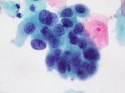 Отмечается Всемирный день борьбы против рака