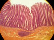 Колопроктологи уповают на "золотой стандарт"