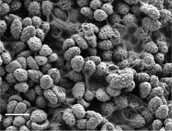 Врач Танг: «супергрибок» передается через кожу