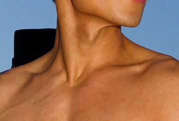 Metro: врачи спутали лимфому у 13-летнего британца с тонзиллитом