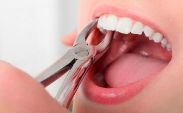 Удаление зуба: что важно знать