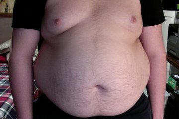 Онколог Бёден: ожирение грозит раком простаты