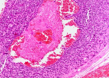 Составлен ТОП-4 признака оторвавшегося тромба: отдышка и боль в груди