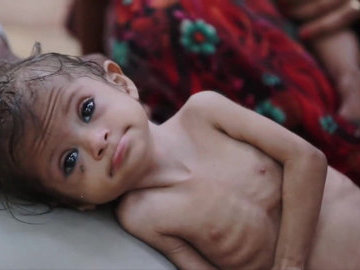 В Австралии родители-веганы чуть на заморили ребенка голодом