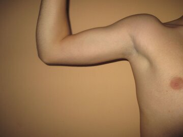 Врач Филева: плохая гигиена подмышек грозит гнойным гидраденитом