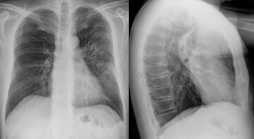 Профессор Пивоварова: туберкулез маскируется под простуду