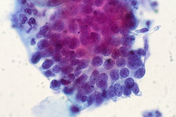 Эндокринолог Островская: анемия приводит к тахикардии и гипотиреозу