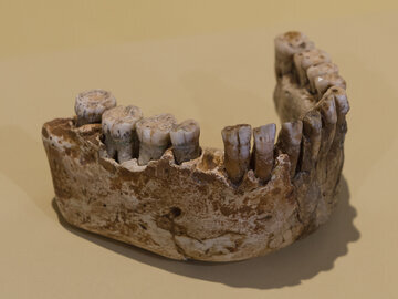 Хирург Давидян: без зуба можно ходить 4 месяца