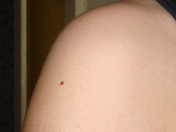 Онколог Маклаков: меланома вызывает изменение цвета родинки