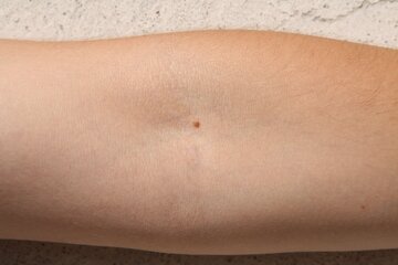 Врач Антонова: опасность родинки не определяется наличием волоса