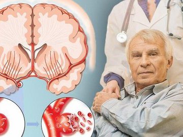 Врачи рассказали, о просто и эффективном способе предотвращения инсульта