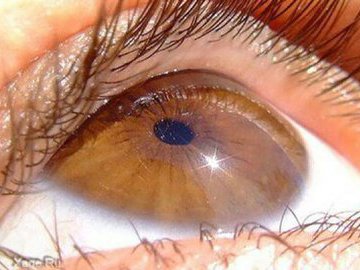 Что такое пигментный ретинит?
