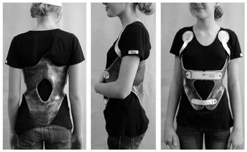 Ортопед Бацаленко: сколиоз не поддается «домашнему» лечению