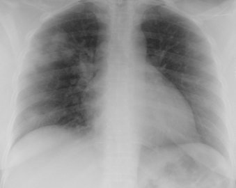 JAMA: предрасположенные к раку легких люди не знают о скрининге